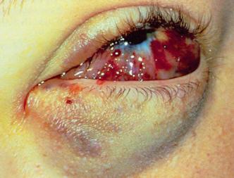 Лимфангиома орбиты глаза лечение