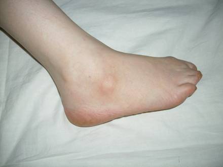 Атерома фото на ноге лечение